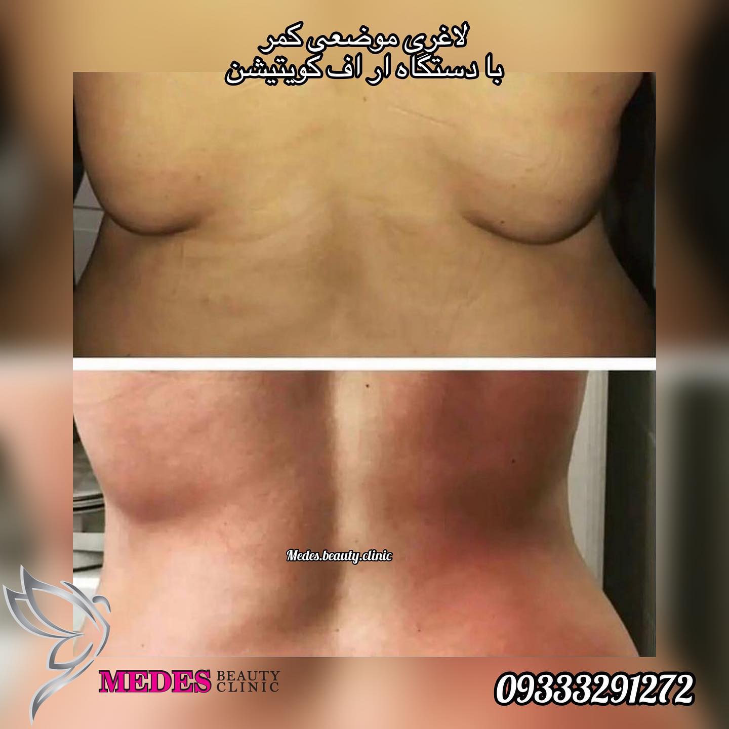 گالری لاغری با دستگاه